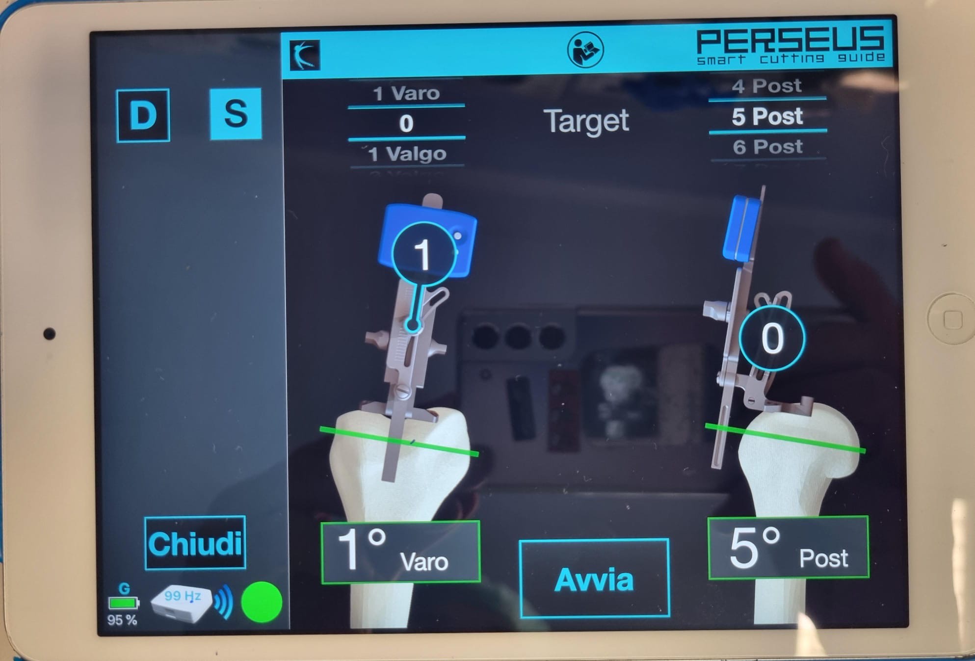 Borgomanero guarda al futuro: Chirurgia Ortopedica Computer Assistita al servizio dei pazienti